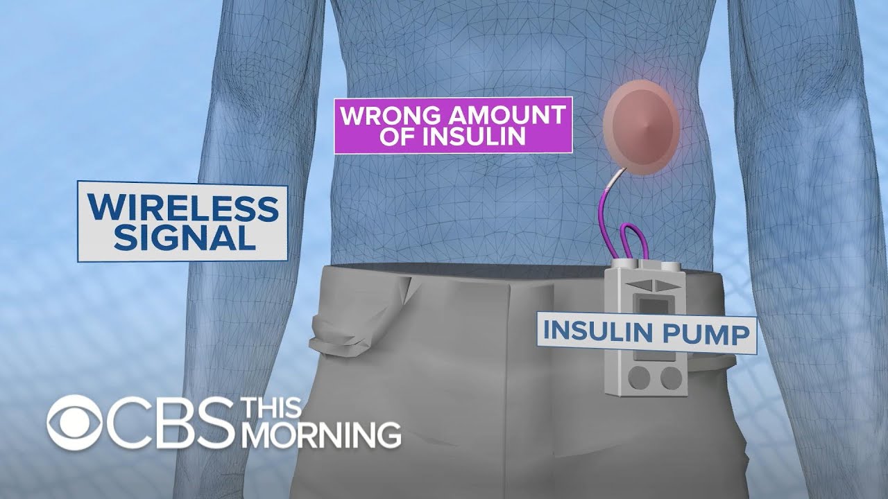 How medical devices like pacemakers, insulin pumps can be hacked